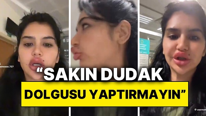 Sürekli Dudak Dolgusu Yaptıran Kadın Soluğu Hastanede Aldı: Alerjik Reaksiyon Sebebiyle Dolguları Erimiyor