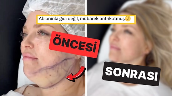 Gıdı Bölgesine Yapılan Estetik Operasyon Sonrası Tamamen Farklı Bir Görünüme Kavuşan Kadın