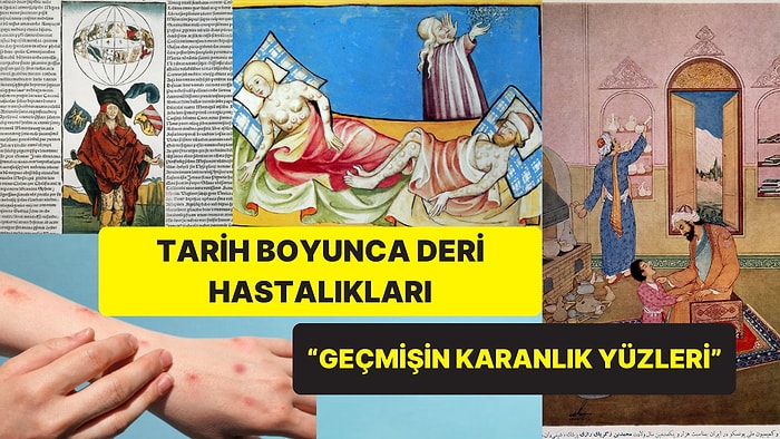 Maymun Çiçeği Gibi Tarih Boyunca İnsanları Etkileyen Bazı Deri Hastalıklarını İnceliyoruz