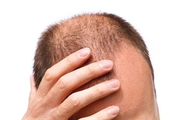 Erkek tipi saç dökülmesi, bilimsel adıyla androgenetik alopesi, genetik bir özelliktir ve birden fazla genin etkisiyle ortaya çıkar. Araştırmalar, erkeklerde saç dökülme riskini artıran bazı gen varyantları tespit etti.