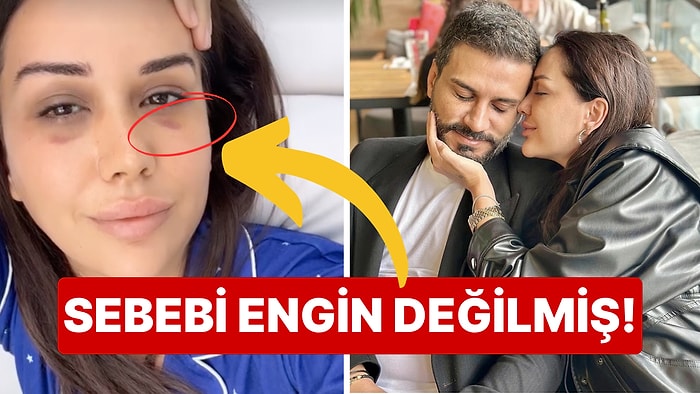 Ablasına Taşınıp Evde Bile Gözlük Takan Dilan Polat'ın Yüzündeki Morlukların Nedeni Nihayet Belli Oldu!