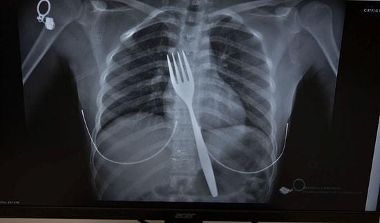 Woman Swallows 18cm Fork: Medical Marvel Set to Become a Scientific Case Study