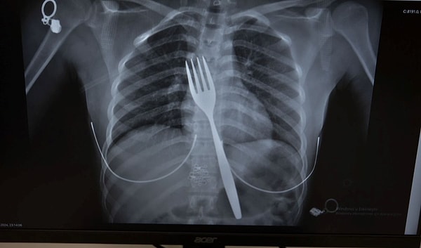 The truth was revealed through an X-ray: an 18-centimeter-long fork was discovered lodged in the esophagus of the 18-year-old foreign patient!