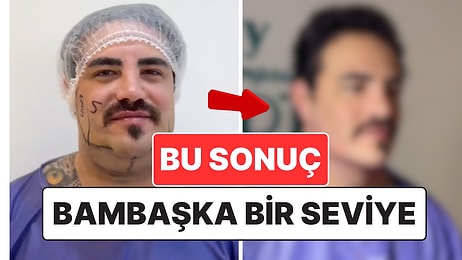 Bu Bambaşka Bir Seviye: Estetik Operasyonla Şaşırtıcı Bir Değişim Geçiren Erkek Hasta