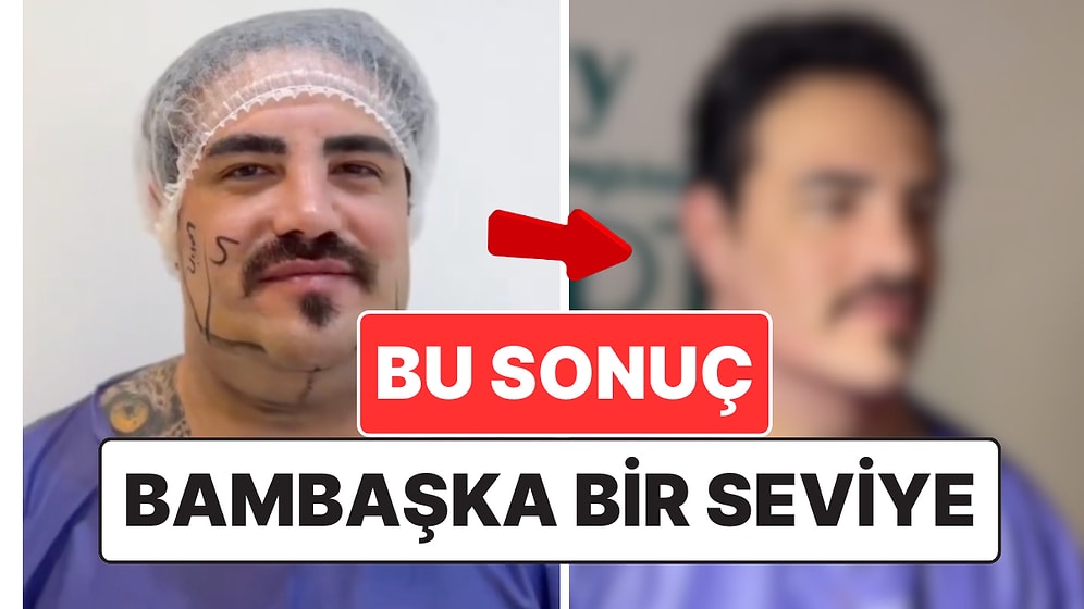 Bu Bambaşka Bir Seviye: Estetik Operasyonla Şaşırtıcı Bir Değişim Geçiren Erkek Hasta