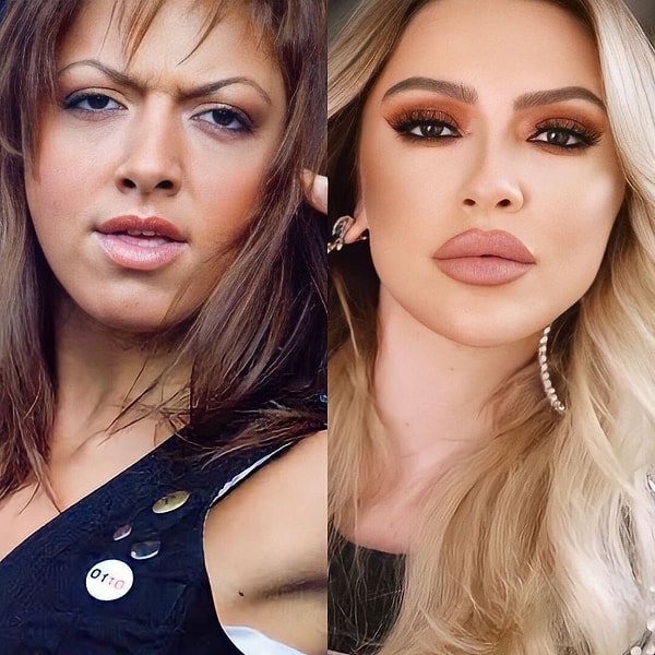 Önce bariz bilinenle başlayalım, Hadise 2009 yılında yani şana şöhrete biraz kavuştuğu gibi burun ameliyatı oluyor. Burun ameliyatının yanında bu fotoğrafta çok net görebileceğiniz üzere kendisini yorgun gösteren göz kapakları da alınıyor.