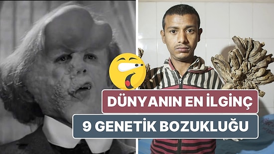 Vampir Hastalığı'ndan Fil Adam Sendromu'na: Dünyanın En İlginç 9 Genetik Bozukluğu