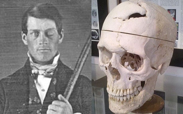 3. Beynine demir çubuk saplanan adam: Phineas Gage