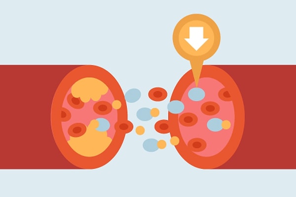 In addition to high cholesterol levels, the buildup of plaque in the arteries of the legs and feet, known as atherosclerosis, can also cause cold feet.