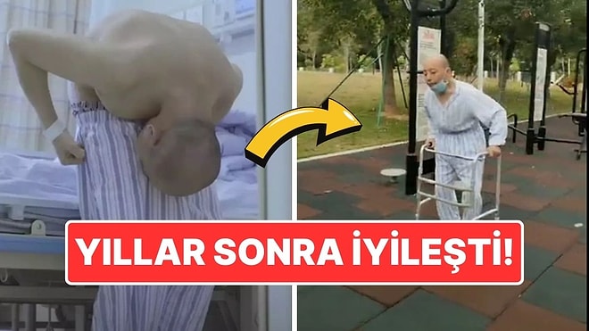 28 Yıl Boyunca Eğik Durmuştu: Nadir Görülen Hastalıkla Mücadele Eden Adam Ameliyatla Yeniden Ayağa Kalktı!