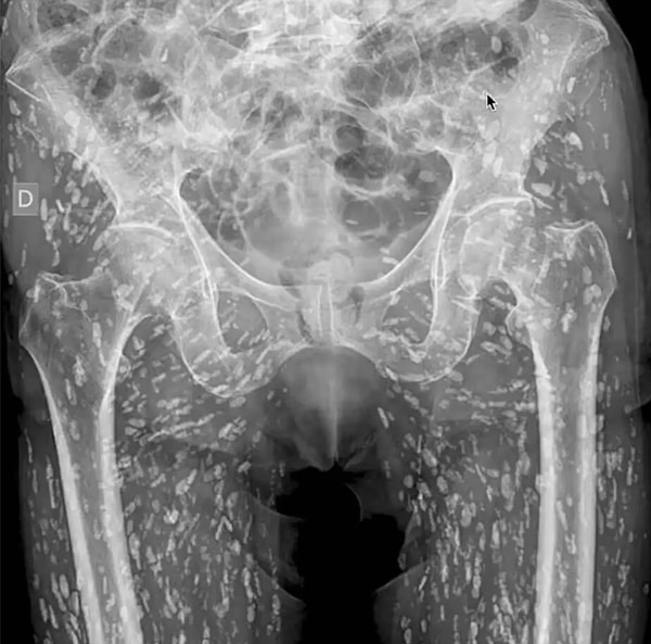 Dr. Ghali, hastanın çiğ ya da az pişmiş domuz eti tüketmiş olabileceğini belirtiyor. Ancak CDC, tek başına domuz eti yemenin cysticercosis'e neden olmayacağını, etin önceden tenyalarla enfekte olması gerektiğini vurguluyor.