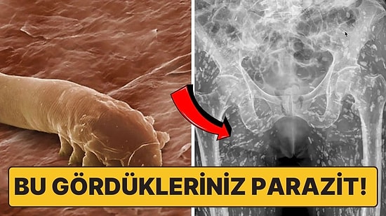 X-Ray Görüntüsü Dehşete Düşürdü! Vücudu İçinde Binlerce Parazit Barındıran Kişinin Yaptığı Büyük Hata