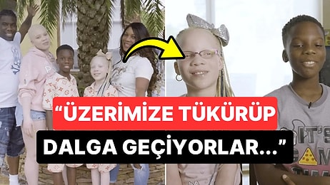 Albino Hastalığına Sahip Çocukları Olduğu İçin Toplumdan Dışlanan Ailenin Üzücü Hikayesi