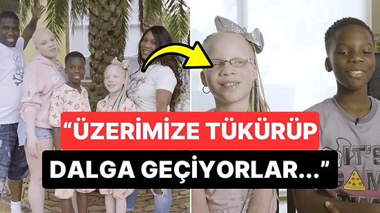 Albino Hastalığına Sahip Çocukları Olduğu İçin Toplumdan Dışlanan Ailenin Üzücü Hikayesi