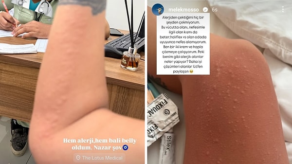 Melek Mosso, geçtiğimiz saatlerde alerjik bünyesinin Bali'ye hiç adapte olamadığını vücudundaki kabarıklıkları göstererek açıkladı.