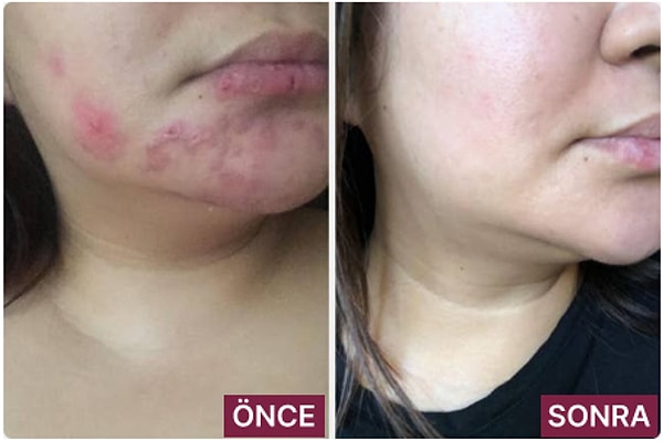 Bio-Oil Cilt Bakım Yağı 60 ml Görseli