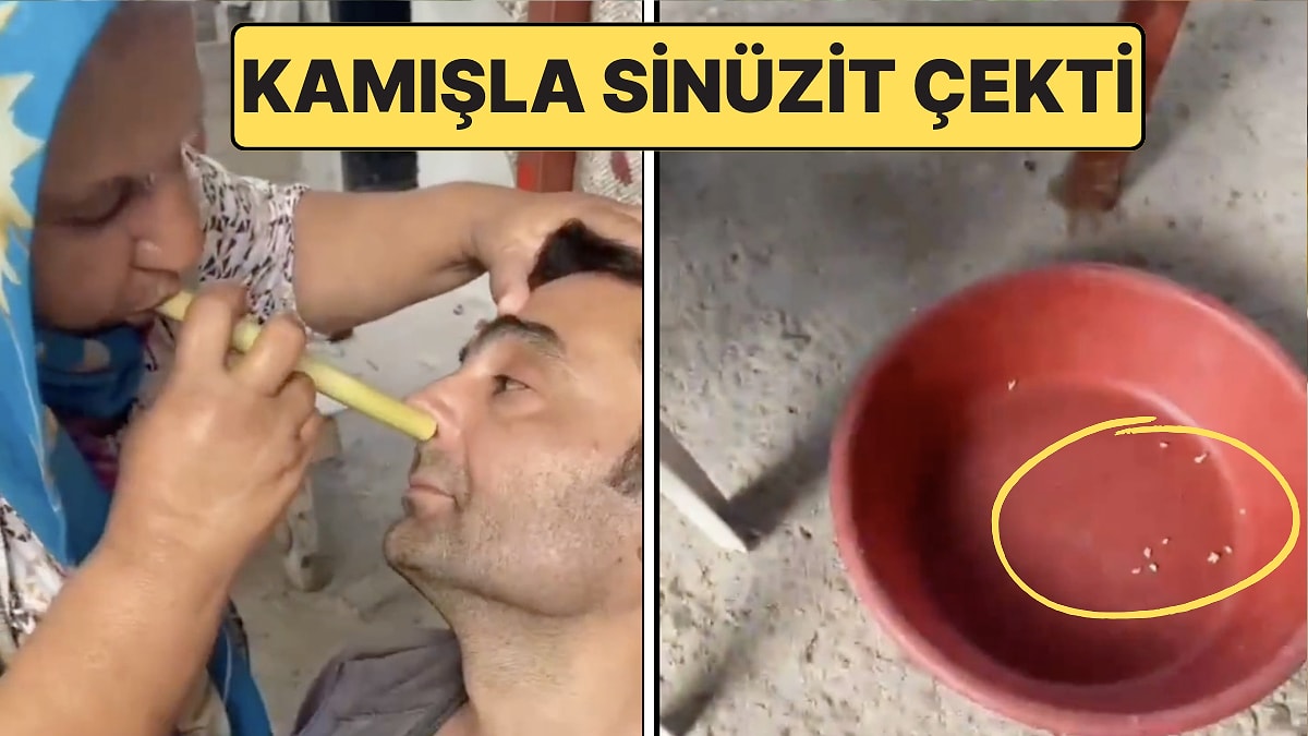 Teyze Sen N&apos;aptın? Adana&apos;da Ağzındaki Kamışla Sinüzit Tedavisi Yapan Kadın Herkesi Dumur Etti