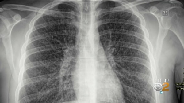 Popcorn lung, yani Türkçeye çevrilmiş haliyle "patlamış mısır akciğeri", kulağa biraz tuhaf gelse de aslında oldukça ciddi bir solunum hastalığı. Görseli