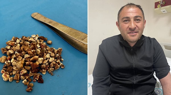 Şiddetli böbrek ağrısıyla hastaneye başvuran oto elektrik ustası Ahmet Yarba'nın her iki böbreğinde çok sayıda taş olduğunu tespit edildi. Görseli
