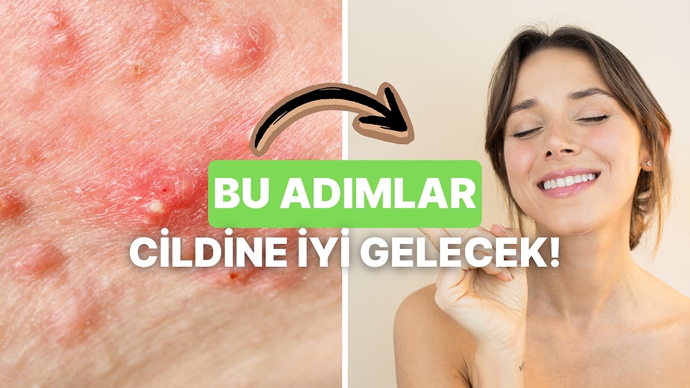 Sivilceyle Problemine Dermatolojik Yaklaşım: Cildini Arındıran ve Yatıştıran 11 Adım