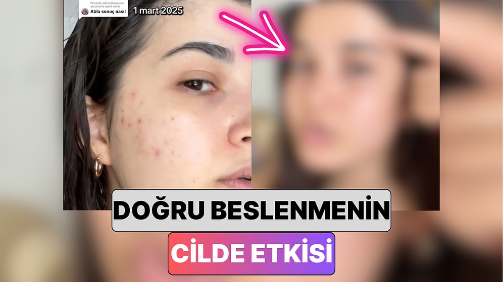 Bir Aylığına Bazı Gıdaları Tüketmeyi Bırakan Kadın Cildinde Meydana Gelen Değişimini Paylaştı!