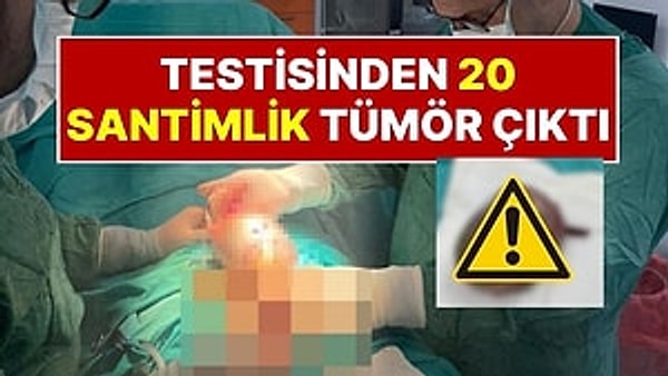 Kahramanmaraş'ta bir hasta, idrar şikâyetiyle başvurduğu hastanede yapılan muayene sonucu testisinde 20 santimetrelik tümörle karşılaştı.