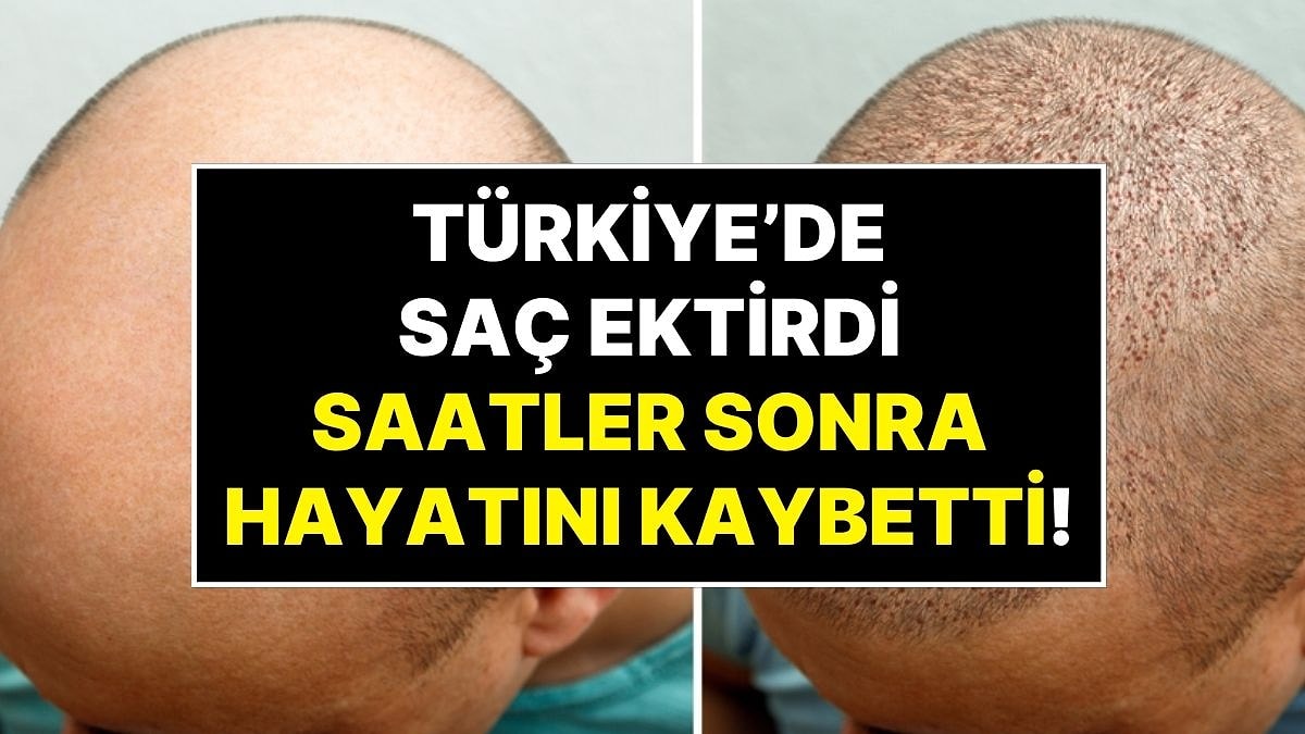 İngiltere&apos;den Türkiye&apos;ye Saç Ektirmeye Gelen Hasta Ameliyat Sonrası Hayatını Kaybetti