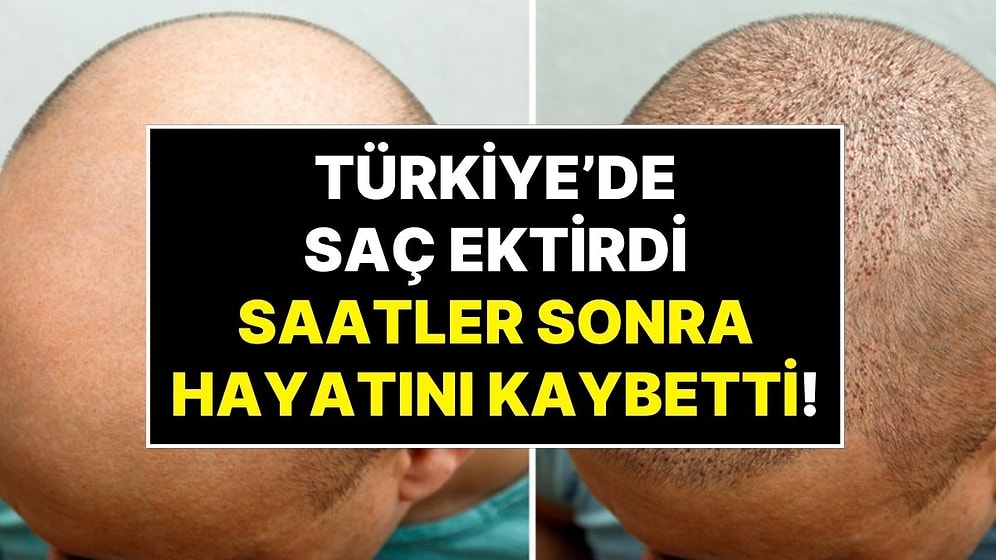 İngiltere'den Türkiye'ye Saç Ektirmeye Gelen Hasta Ameliyat Sonrası Hayatını Kaybetti