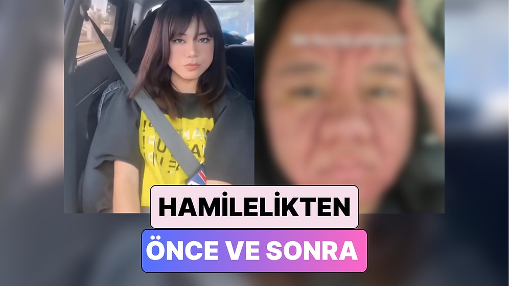 Bir Kadın Hamileliği Sırasında Yaşadığı Bir Alerjik Reaksiyon Sebebiyle Yüzünün Geldiği Hali Paylaştı