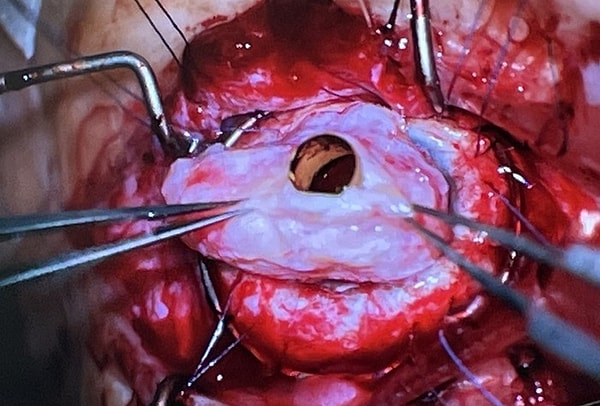 Dişten Göz Operasyonu: Osteo-Odonto-Keratoprosthesis