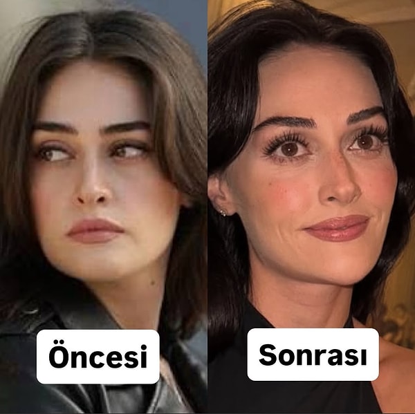 Ancak Esra Bilgiç’in magazin gündemini en çok meşgul eden gelişme, yaptırdığı estetik operasyonlar oldu.