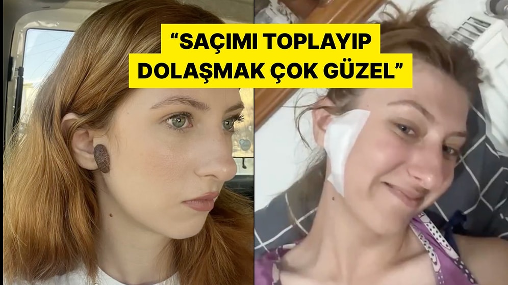 Doğduğundan Beri Yüzünde Olan Beni Aldıran Kadın Deneyimlerini Anlattı