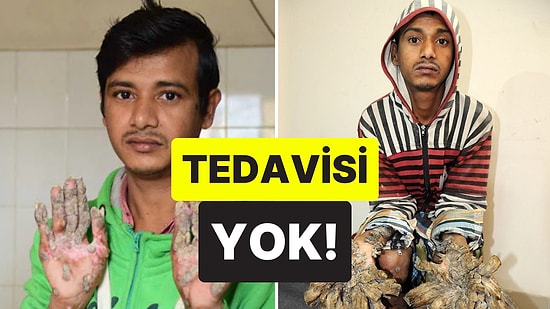 Elleri ve Ayakları Anormal Bir Şekilde Kabuklanıyor: "Ağaç Adam" Olarak Bilinen Adamın Trajik Hayatı