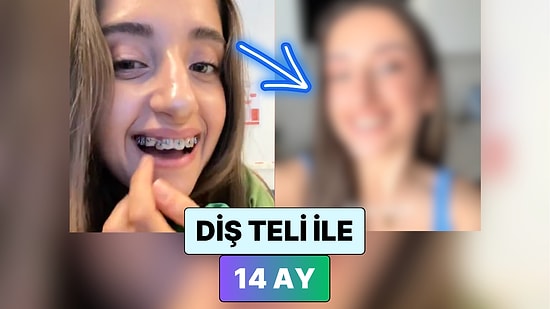 Diş Teli Taktıran Bir Kadın 14 Ayda Dişlerinin Geldiği Durumu Paylaştı