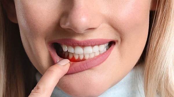 2. Diş etlerin nasıl peki?