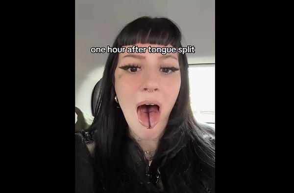 Are there any drawbacks to the tongue splitting procedure? Is it possible to restore the tongue to its original state after undergoing a Tongue Split operation?