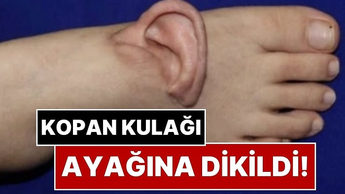 Kopan Kulağı Ayağına Dikildi! Tıbbın Sınırlarını Zorlayan İnanılmaz Kurtuluş Hikayesi