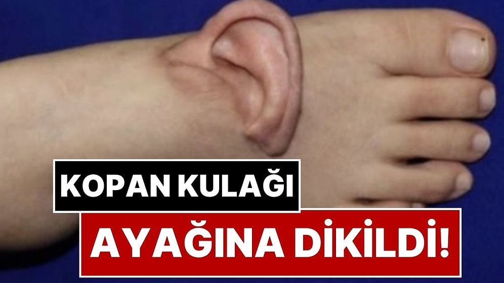 Kopan Kulağı Ayağına Dikildi! Tıbbın Sınırlarını Zorlayan İnanılmaz Kurtuluş Hikayesi