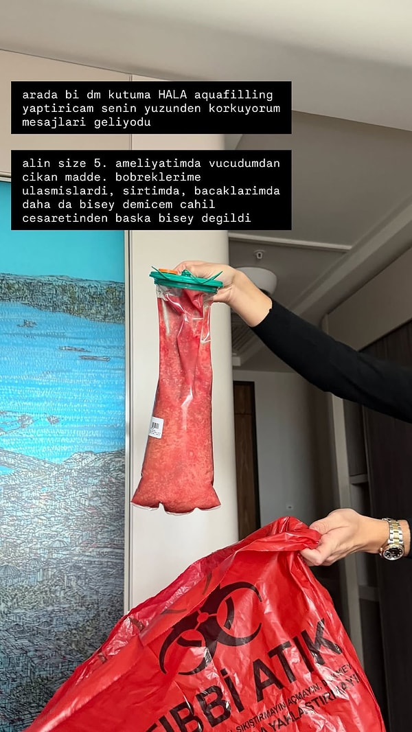 Geçtiğimiz hafta sosyal medyada en çok konuşulan konulardan bir tanesi hiç şüphesiz Danla Bilic'in dolgularını erittikten sonra vücudundan çıkanlardı.