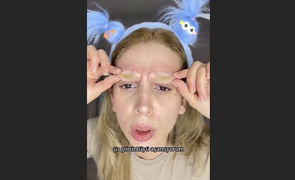 Zaten alerjisi olduğunu belirtti.