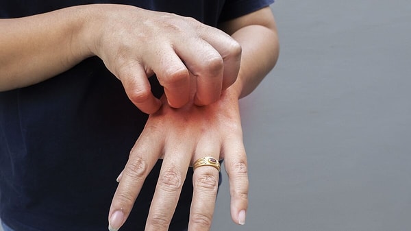 Temas sonrası belirtiler zamanla daha belirgin hale geliyor