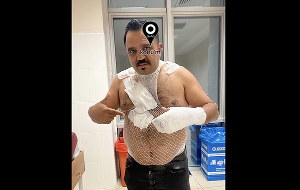 Vücudunda yanıklar oluştu.