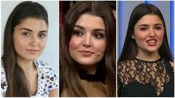 Göz kapağı ve kaş kaldırma (badem göz): Göz yapısının daha çekik, kaşların ise daha kalkık görünmesi bu tip bir müdahale ihtimalini güçlendiriyor.