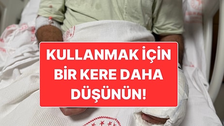 Patlayan Sıcak Su Torbası Nedeniyle Vücudunun Yüzde 30’u Yandı