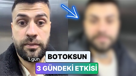 Botoks Yaptıran Bir Adam 3 Gün İçinde Yüzünde Meydana Gelen Değişimi Paylaştı