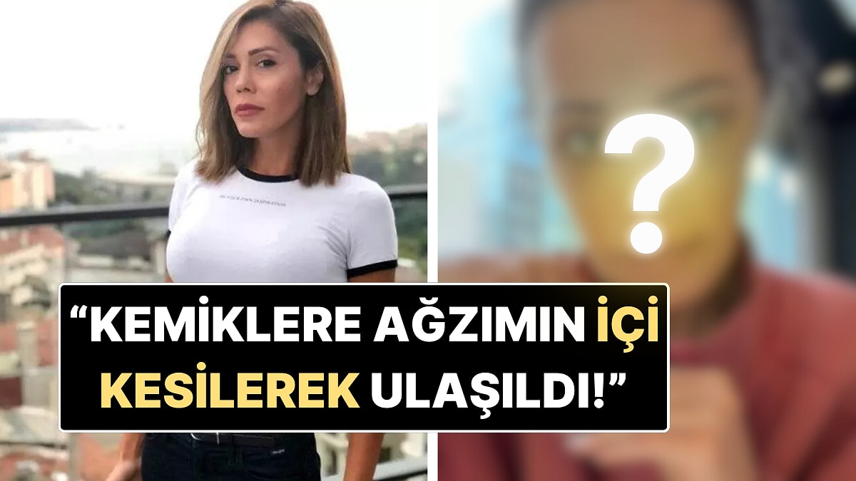 Yüz Nakli Yaptıran Didem Ceran Operasyondan Sonraki Halini Paylaştı