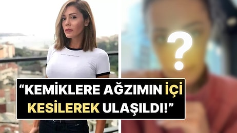 Yüz Nakli Yaptıran Didem Ceran Operasyondan Sonraki Halini Paylaştı