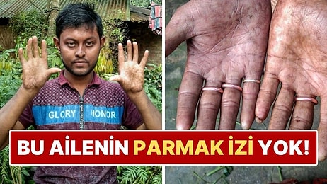 Parmak İzi Olmadan Yaşıyorlar! Bangladeşli Ailenin Hayatını Zorlaştıran Nadir Hastalık