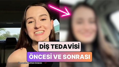 Diş Teli Tedavisi ve Çene Ameliyatı Geçiren Bir Kadın Yaşadığı Değişimi Paylaştı