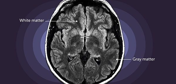 Peki beyinde gri maddenin azalması bir tehlike mi?